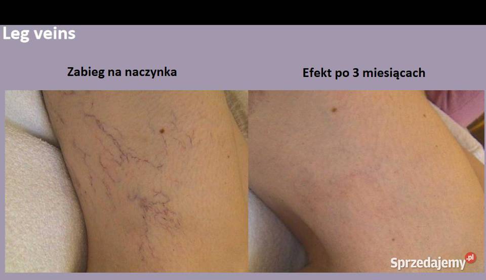Laser medycznyzamykanie naczynek epilacja foto Rybnik