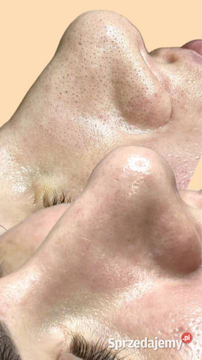 Oczyszczenie wodorowe Świeżość którą widać razu Chorzów