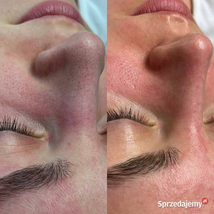 Oczyszczenie wodorowe Detoks skóry w nowoczesnym sprzedam