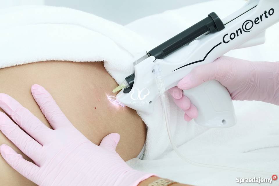 Karboksyterapia CosmoBelle Clinic