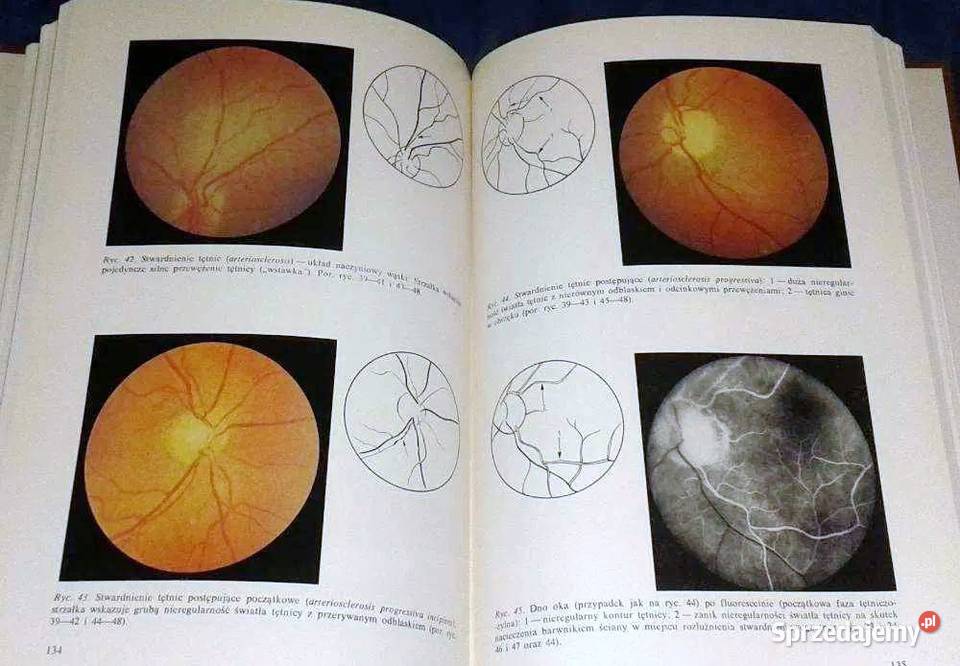 Dno oka w nadciśnieniu tętniczym Edward Bryk Pozostałe Chełm