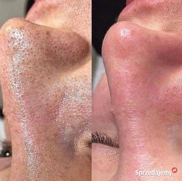 Oczyszczenie wodorowe Czysta skóra czysta śląskie Chorzów sprzedam