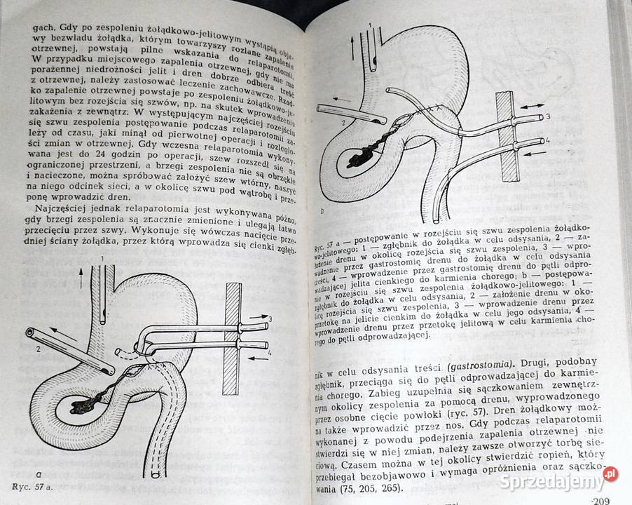 Wczesne powtórne otwarcie jamy brzusznej Leszek Rok wydania 1987 Chełm