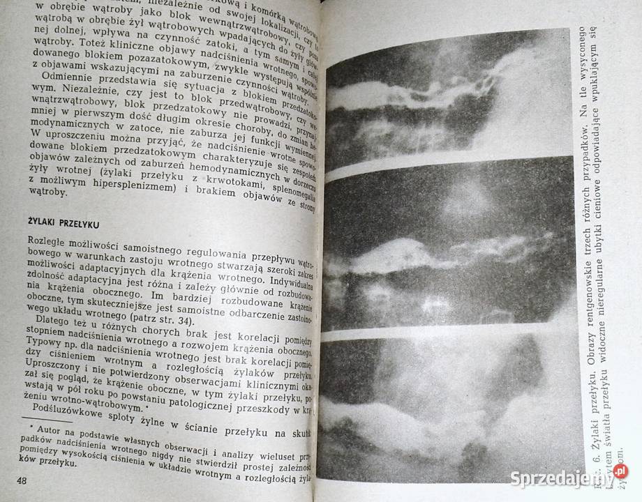 Nadciśnienie wrotne Jerzy Szczerbań Chełm sprzedam