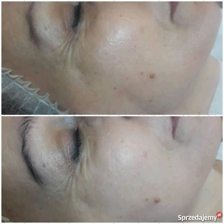 PROMOCJA HIFU lifting skóry 1599 Gorzów Wielkopolski