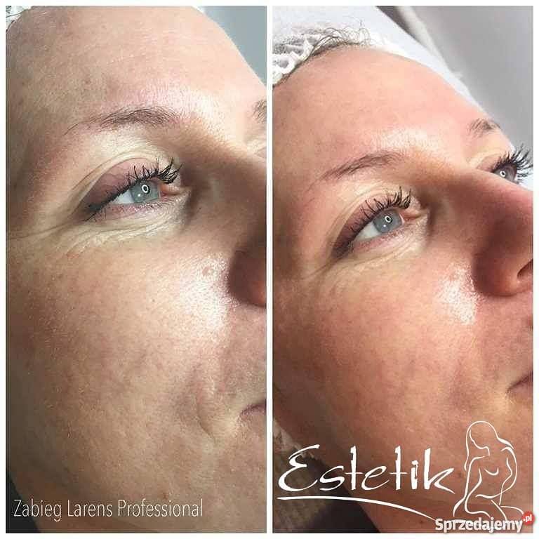 BIOPEPTYDY Rewolucja bez skalpela LARENS lubuskie Gorzów Wielkopolski