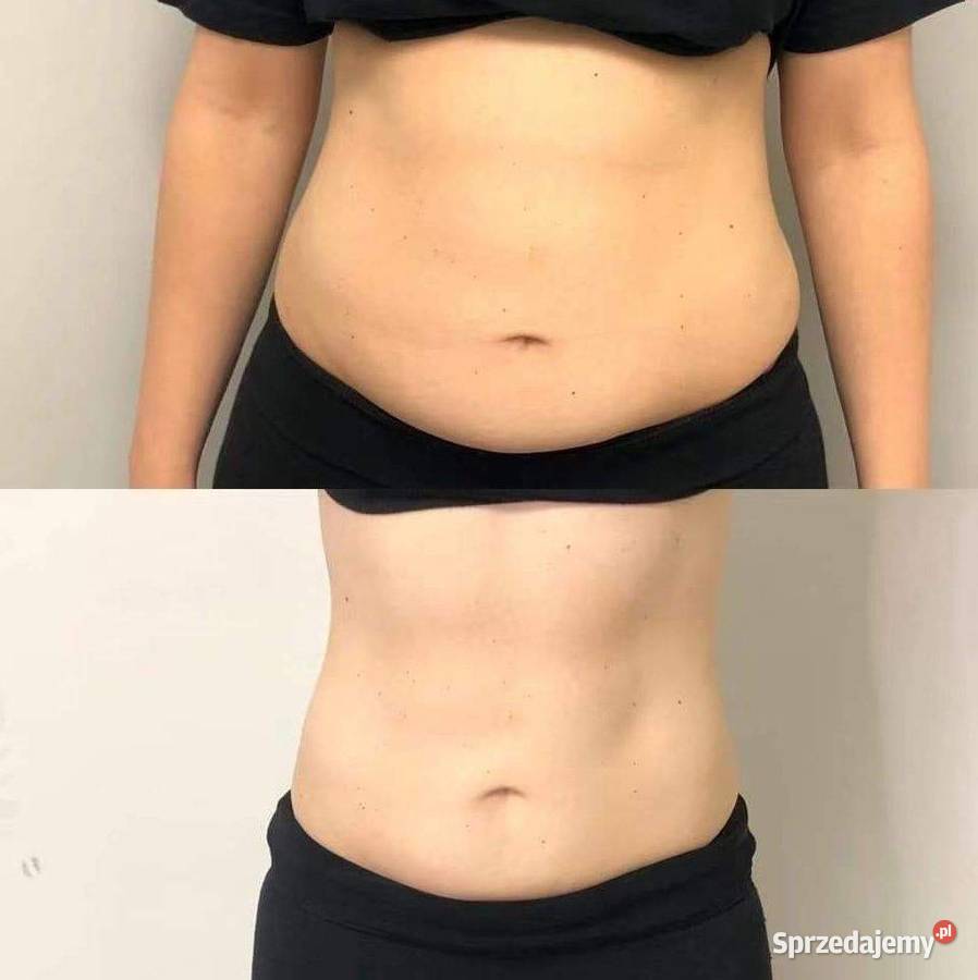 EMS Stymulator mięśni Silver szkolenie pomorskie Słupsk