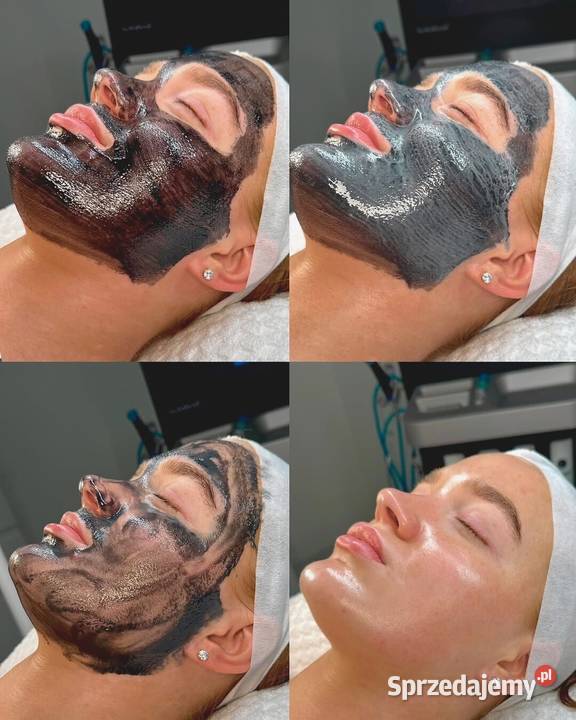 Peeling węglowy Pożegnaj zaskórniki dzięki śląskie Chorzów