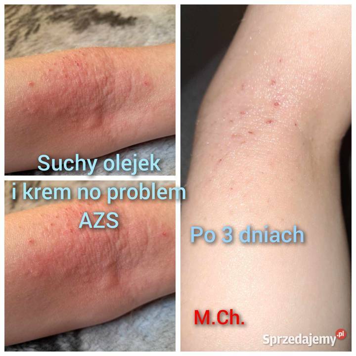 Krem NO PROBLEM Łuszczyca AZS Sucha skóra Dla kobiet Hajnówka