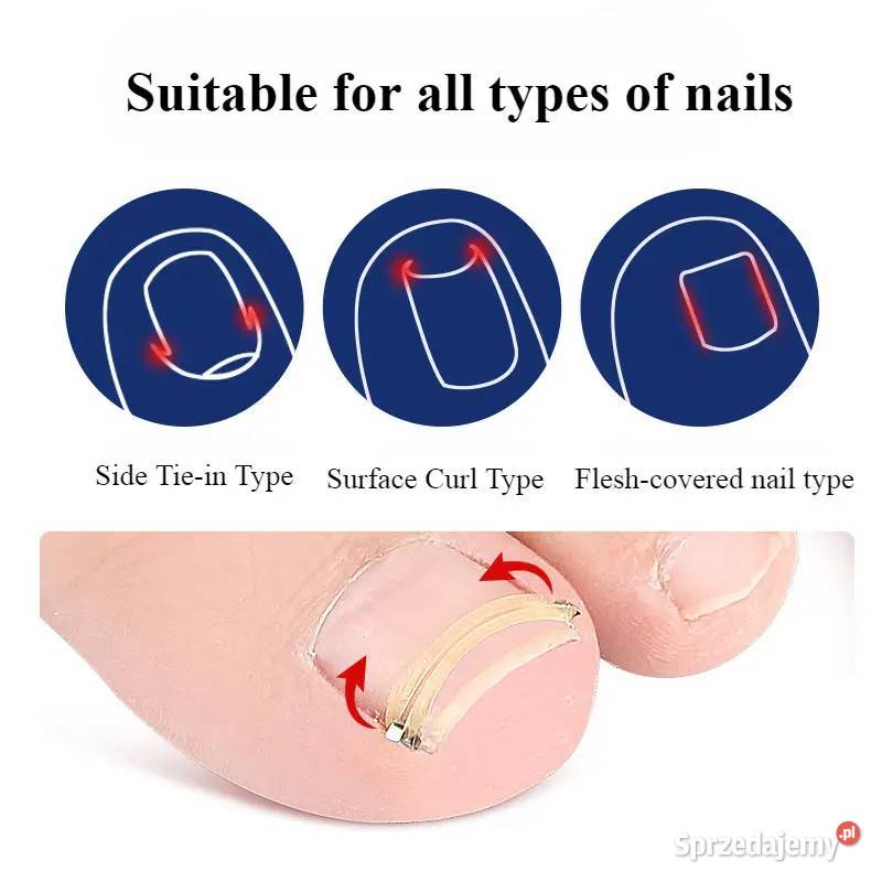 Wrastające Paznokcie Zestaw Korekcyjny AS mazowieckie Płock