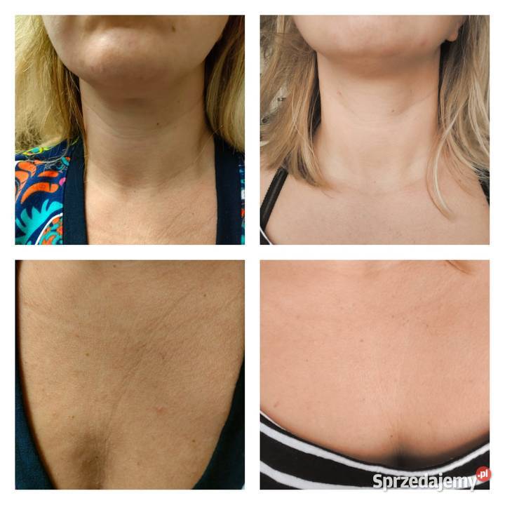 LARENS LipoColl HA Hydro Serum Pielęgnacja Działdowo