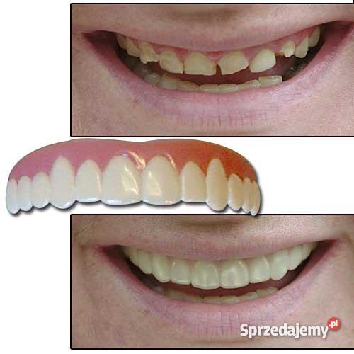 wybielone zęby w 5 minut Szczecin