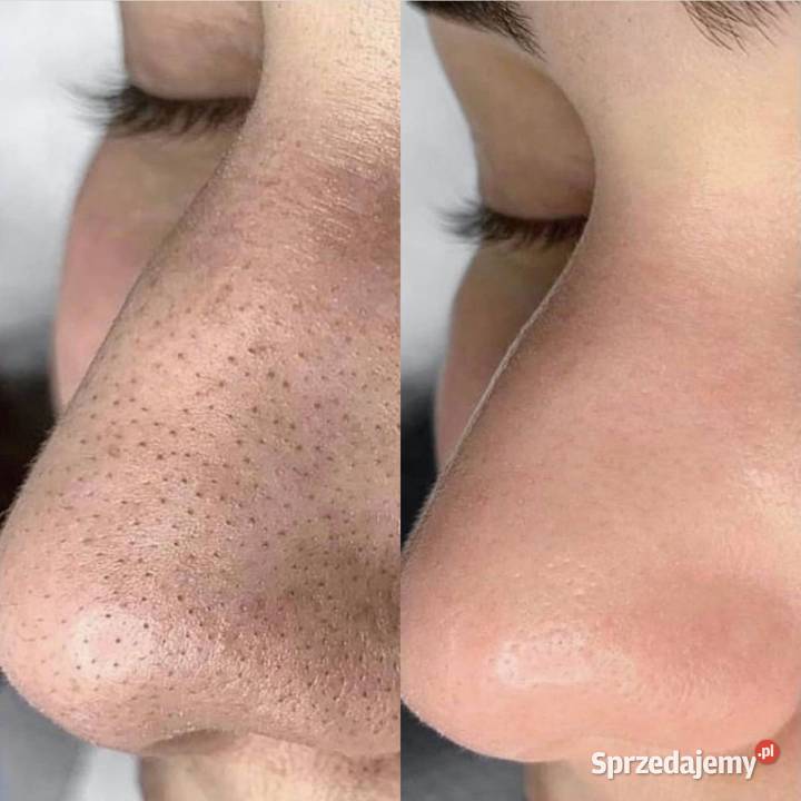 Oczyszczenie wodorowe czysta skóra to 998 Chorzów sprzedam