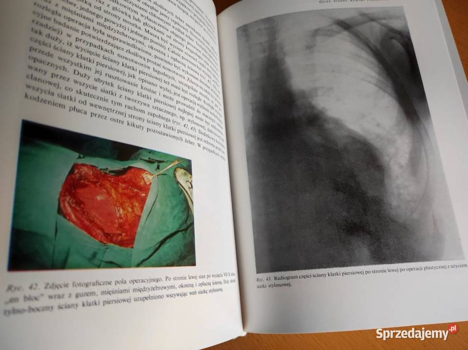 Chirurgia układu oddechowego Wit Rzepecki Jan ISBN 9788320057218 Kielce