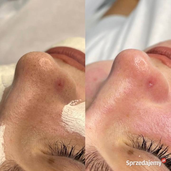 Oczyszczenie wodorowe Delikatne a skuteczne Chorzów