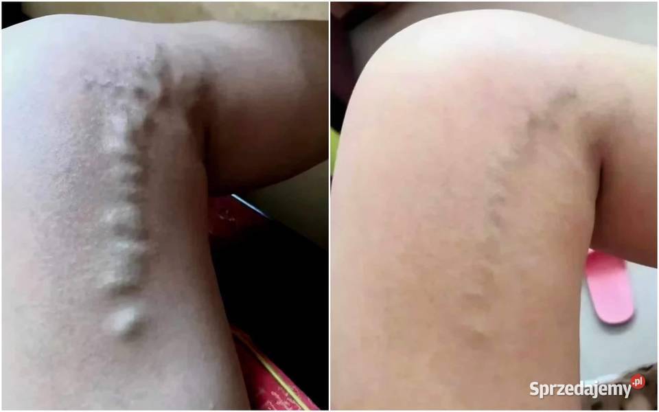 Venotonic żel chłodzący na zmęczone nogi żylaki podlaskie