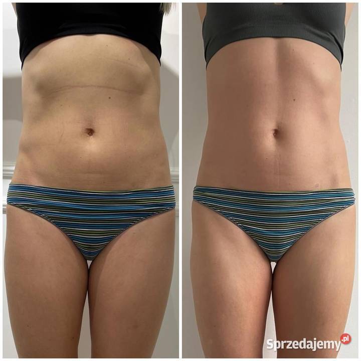 Icoone laser wynajem Warszawa