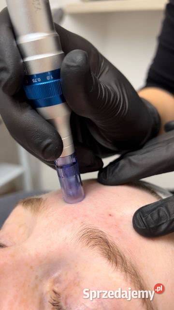 Oczyszczanie wodorowe zdrowa promienna skóra Chorzów