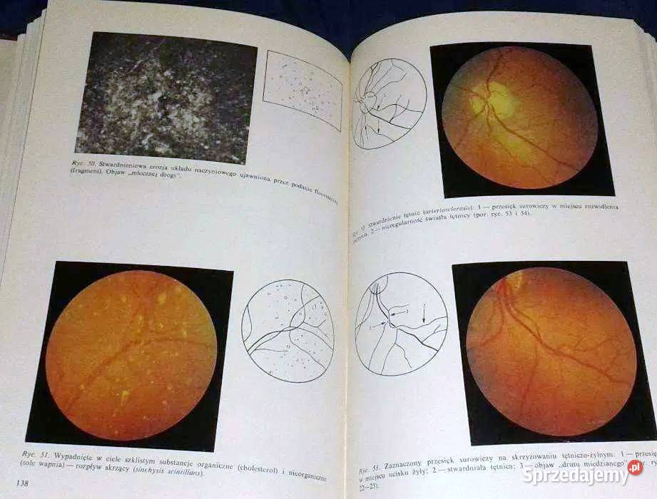 Dno oka w nadciśnieniu tętniczym Edward Bryk lubelskie