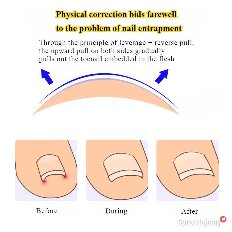 Wrastające Paznokcie Zestaw Korekcyjny AS Płock sprzedam
