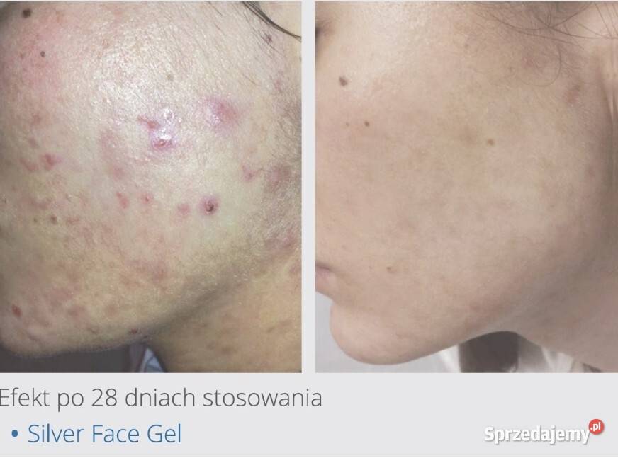 LARENS Silver gel Skóra problematyczna 50 ml Unisex sprzedam