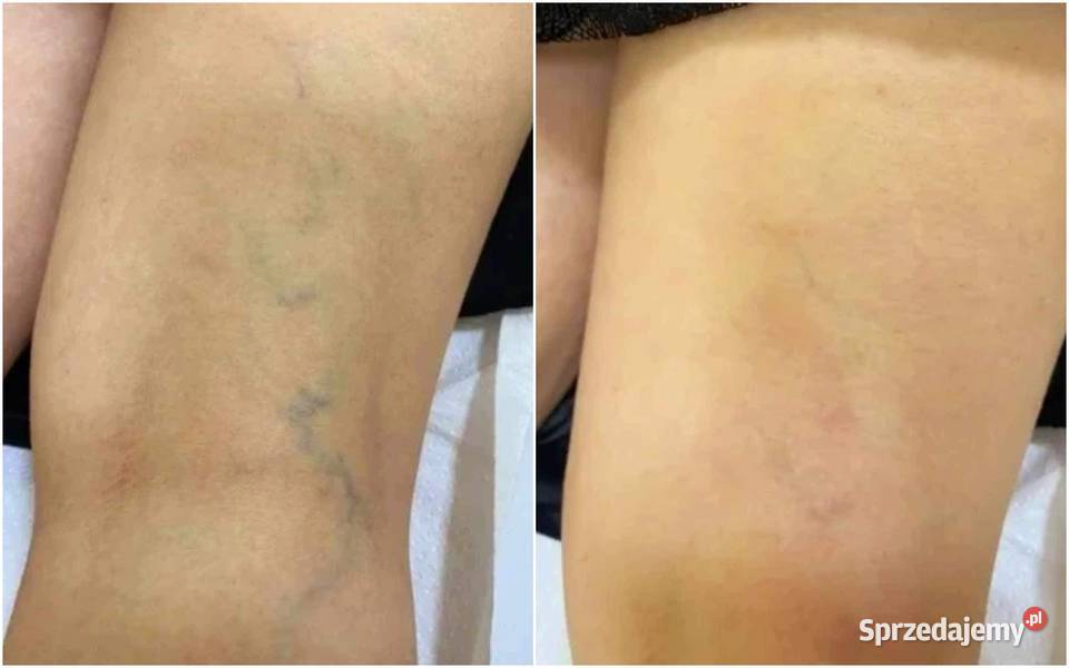 Venotonic żel chłodzący na zmęczone nogi żylaki Hajnówka