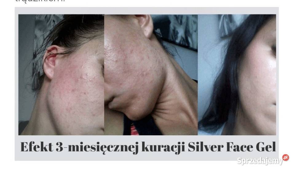 LARENS Silver gel Skóra problematyczna 50 ml warmińsko-mazurskie Działdowo