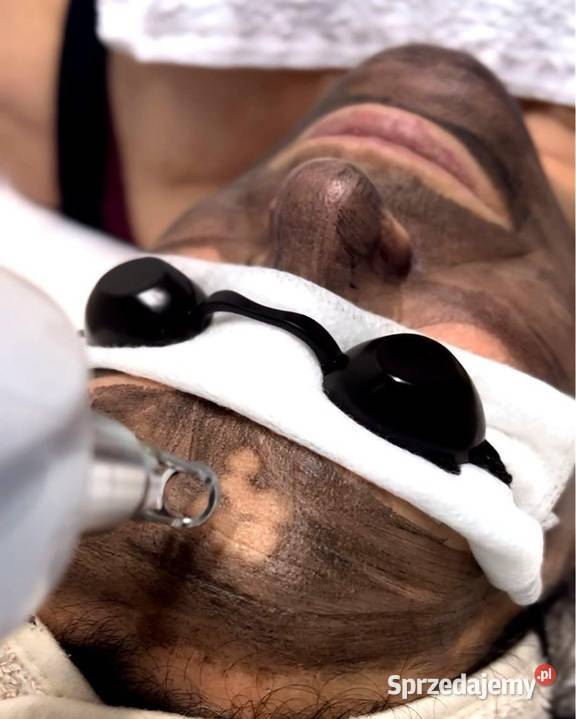 Peeling węglowy laserowy sposób na młodszą skórę śląskie Chorzów