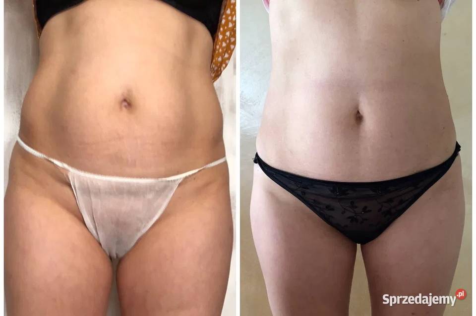 BodyLab Asclepion