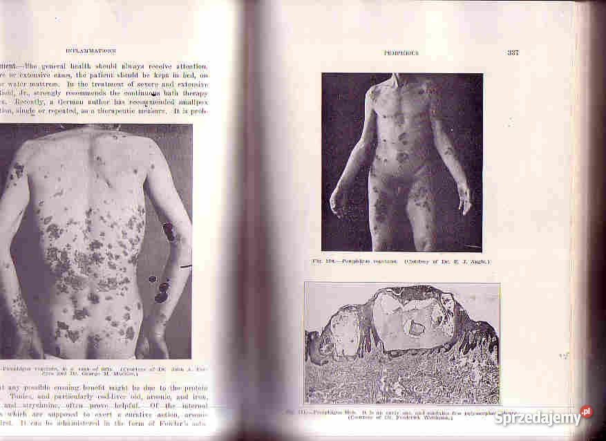 390 DISEASES OF THE SKIN SUTTON THE C V MOSBY CO Książki naukowe i popularnonaukowe małopolskie Czyrna sprzedam