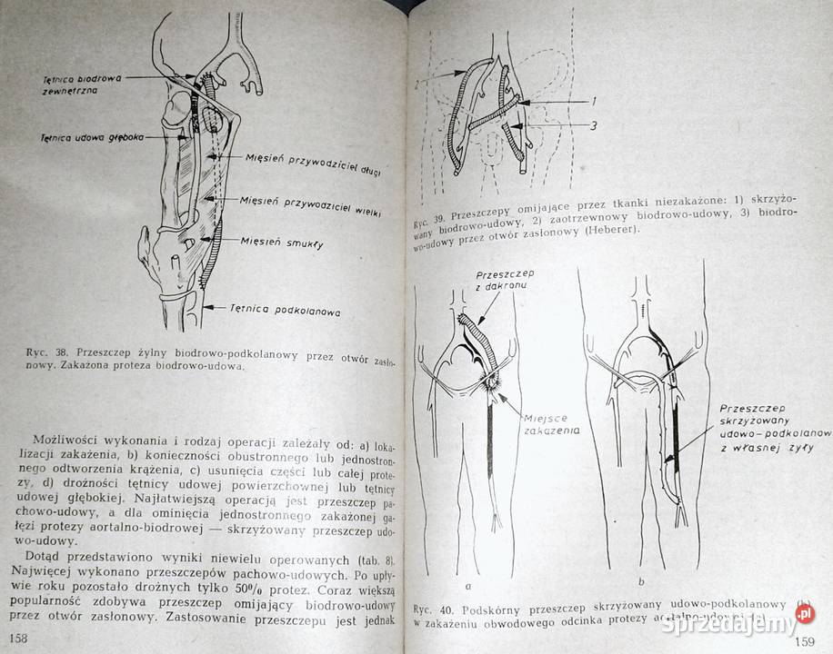 Powikłania operacjach naczyń krwionośnych H Chełm