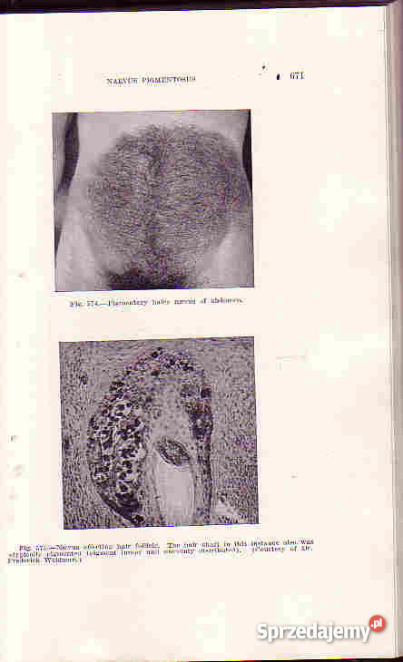 390 DISEASES OF THE SKIN SUTTON THE C V MOSBY CO