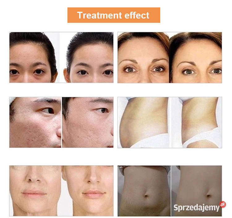 karboksyterapia urządzenie Co2 odmładzanie skóry sprzedam