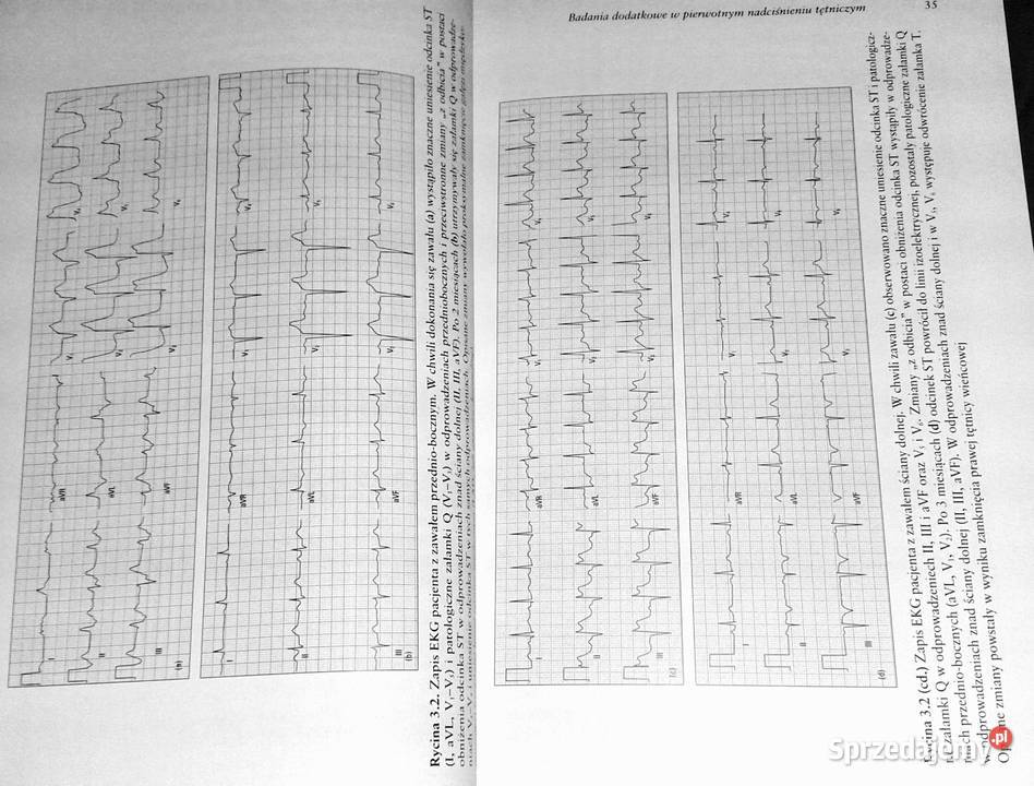 Nadciśnienie tętnicze i choroby współistniejące Kultura i Rozrywka Chełm