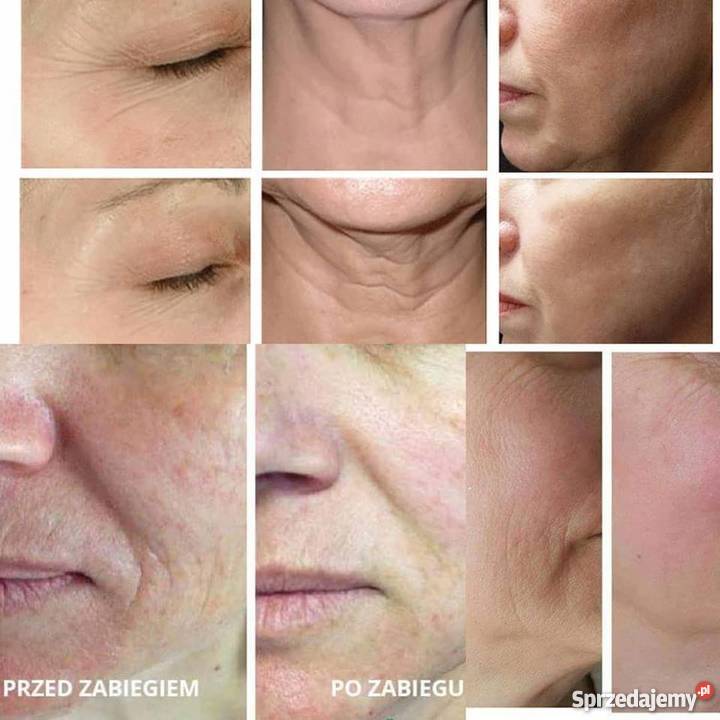 PROMOCJA HIFU lifting Gorzów Wielkopolski