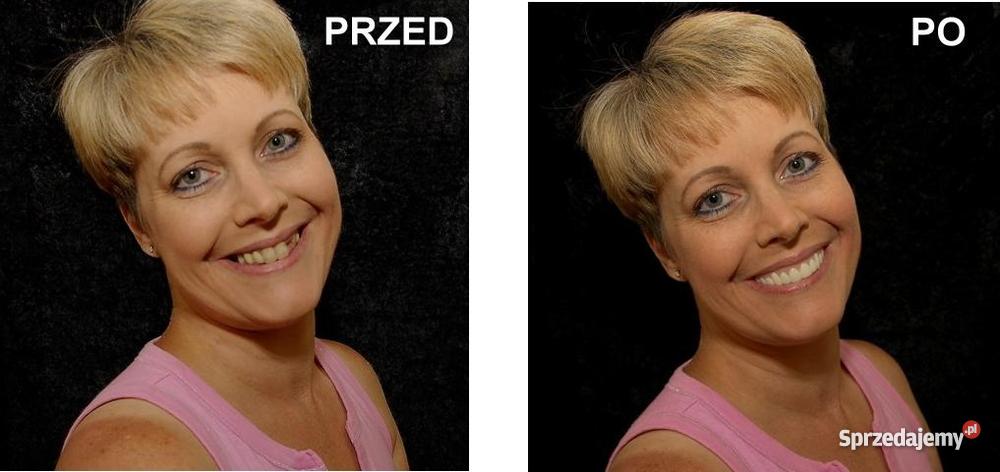 RÓWNE I WYBIELONE ZĘBY W PIĘĆ MINUT