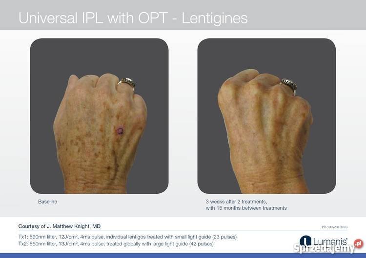 M22 Luenis Coherent Polska małopolskie