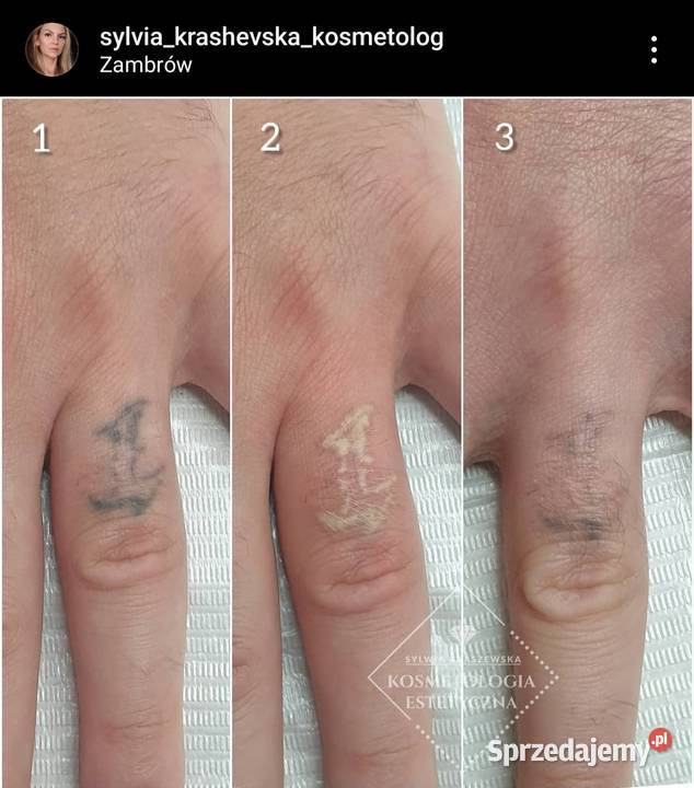 Sprzedam laser QSWITCH do usuwania tatuaży Wyposażenie salonów Zambrów