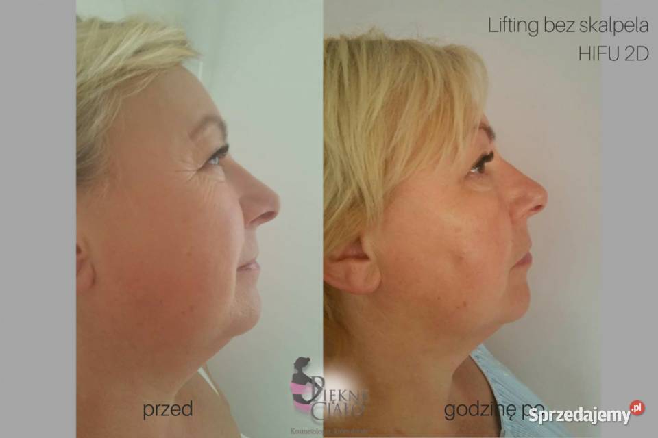 Urządzenie HIFU 2D najmocniejszy bezinwazyjny Opole