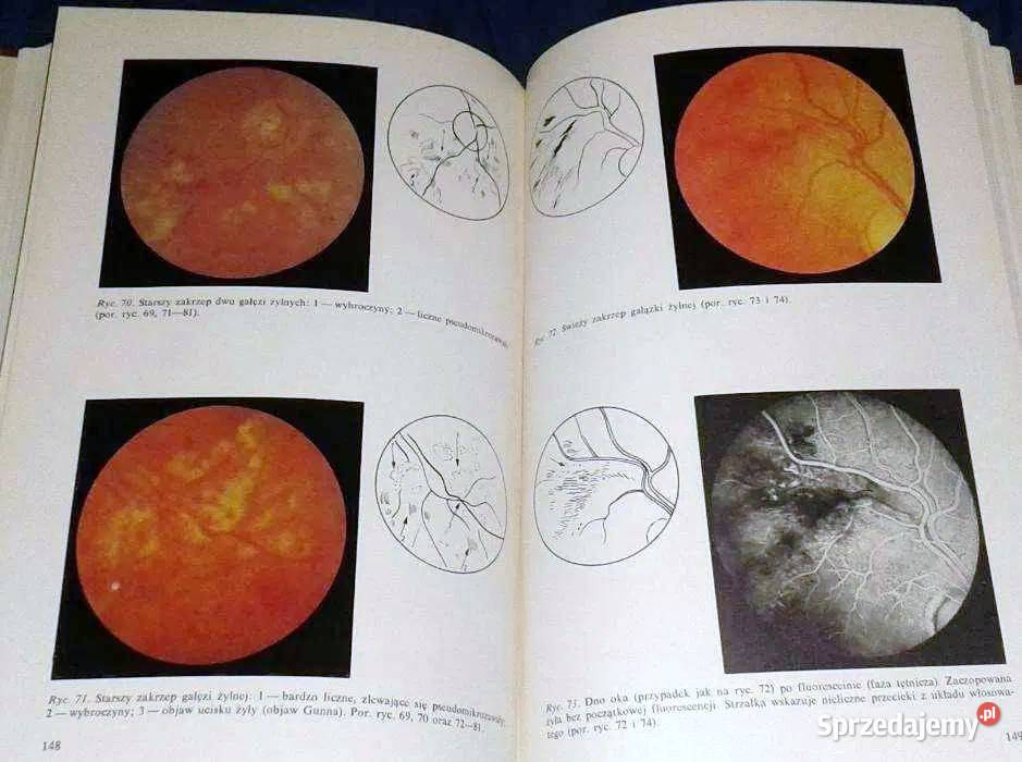 Dno oka w nadciśnieniu tętniczym Edward Bryk