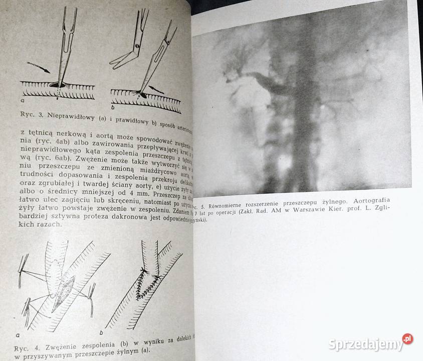 Powikłania operacjach naczyń krwionośnych H sprzedam