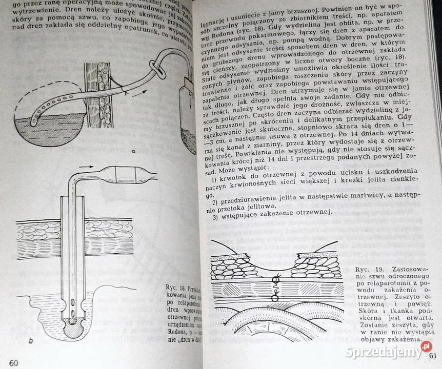 Wczesne powtórne otwarcie jamy brzusznej Leszek lubelskie Chełm