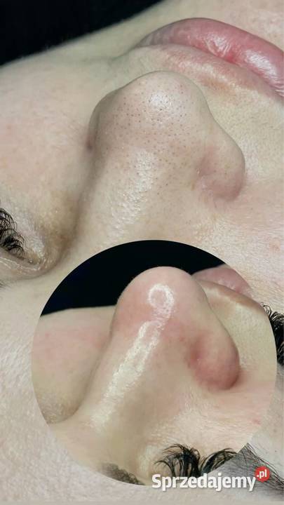 Oczyszczenie wodorowe Chorzów