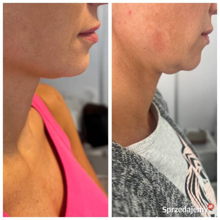 Rf Frakcyjny zachodniopomorskie Szczecin