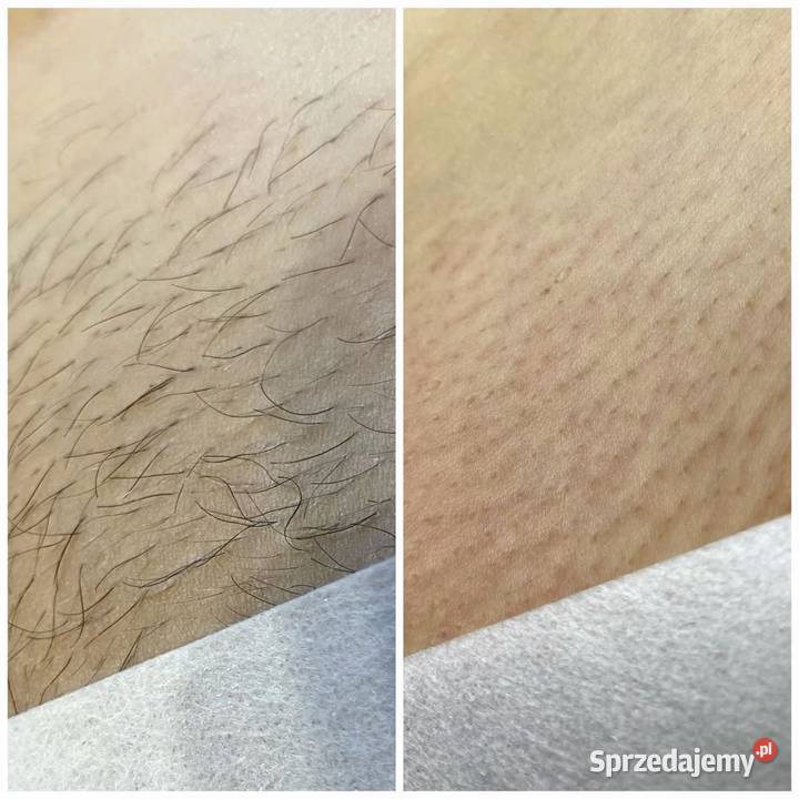 Depilacja cukrowa Słodycz skóry nie włosków Chorzów