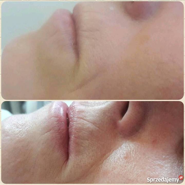 PROMOCJA HIFU lifting skóry 1599 lubuskie