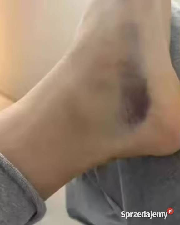 Laserowe usuwanie stłuczeń skręcone kostki bóle Szprotawa