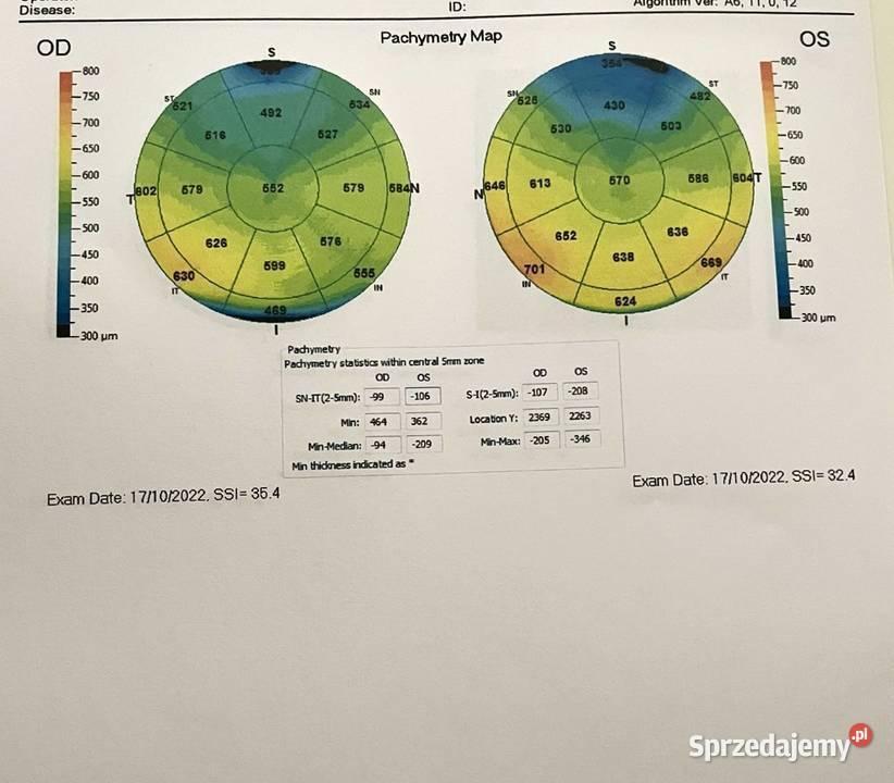 Oct Soct tomograf okulistyczny Łódź