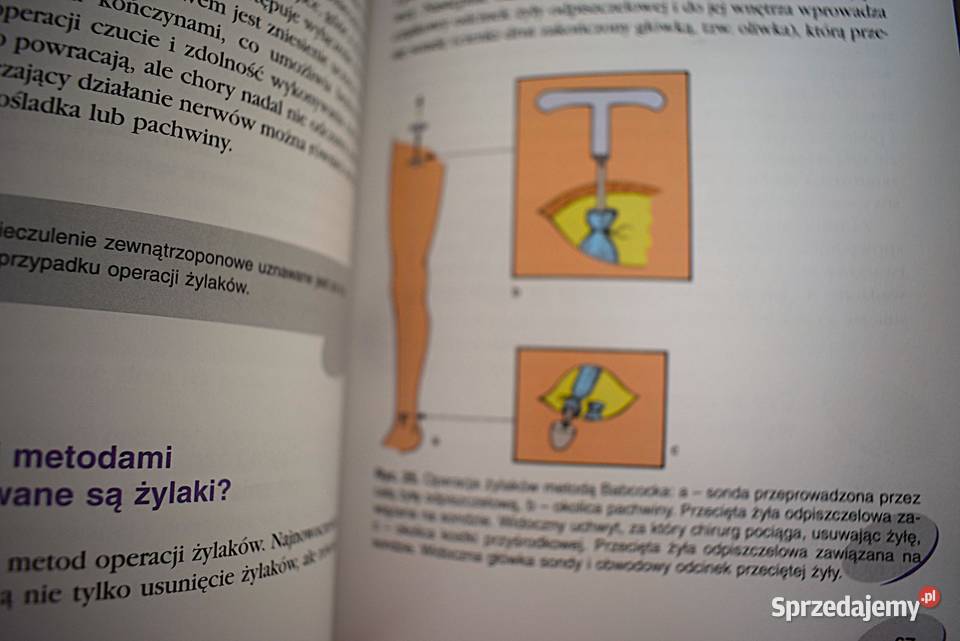 Żylaki leczenie profilaktyka przyczyny objawy Chełmno