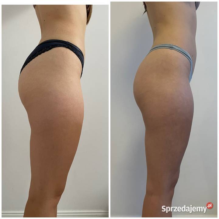 Icoone laser wynajem Warszawa